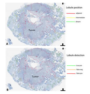 Prerequisites to capture the spatial aspects of the breast cancer -associated inflammatory resonse in the tumor microenvironment: Object-oriented image analysis to detect mammary gland lobules adjacent to hereditary breast cancer. 
A - classification of lobules according to their distance to the tumor. 
B - An important tool for for statistical assessment of sensitivity and robustness of automated pattern recognition, in this example by manual annotation of true positive, false positive, and false negative results. (Image by Anne Grote et al., Published: 19 December 2014 © 2014 Grote et al.; licensee BioMed Central Ltd.)