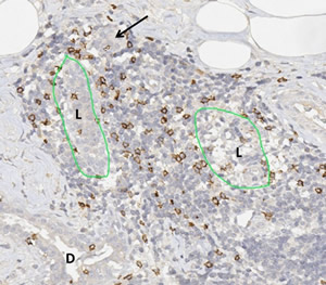 Lymphozytic lobulitis in a case of hereditary breast cancer.